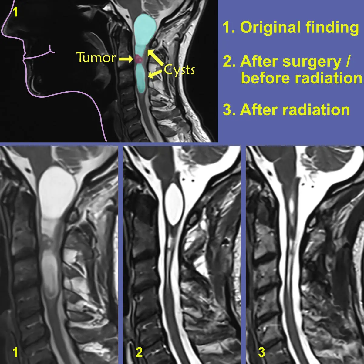 MRI scans before and after the operation